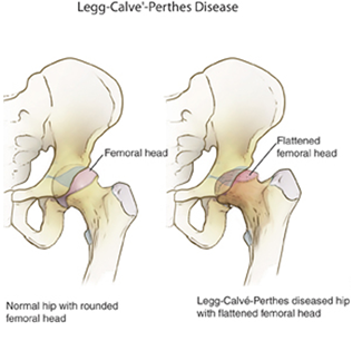 Legg-calve-Perthes-Disease