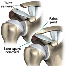 ACJoint