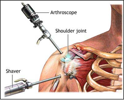 Arthroscope