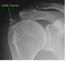 Calcific Deposit