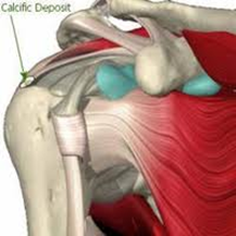 Calcific Deposit2