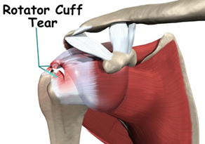 CuffTear