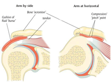 Impingement