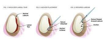 Labral