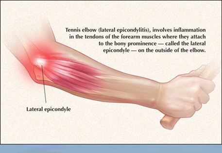 Lateral Epicondyle