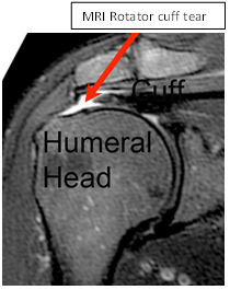 MRIrotatorCuffTear