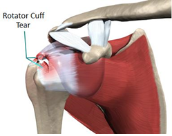 Rotator Cuff