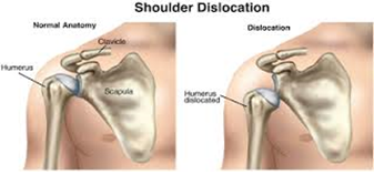 ShoulderDislocation