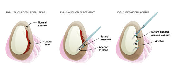 ShoulderLabral