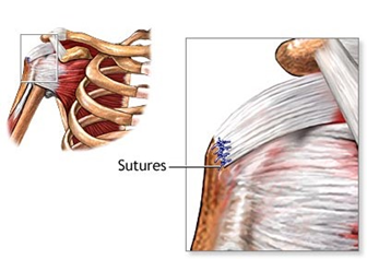 Sutures