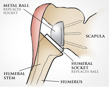 reverseshoulder