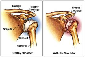 shoulderreplace