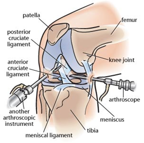 ArthroscopicKneeSurgery