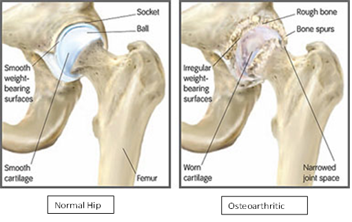 Totalhipreplacement1