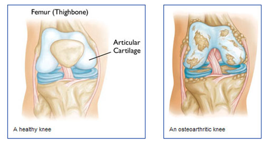 osteoarthriticknee1