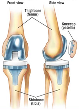 osteoarthriticknee