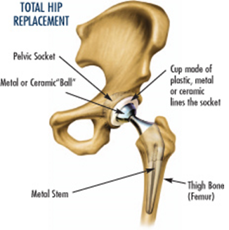 totalhipreplacement2